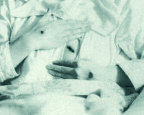 Teresa Neumann: Vết thánh trên tim và tay (Ảnh y khoa, 1926)